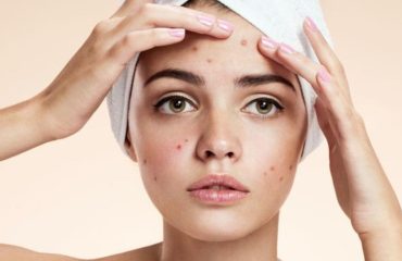 Acne, From Beauty to Self-Confidence