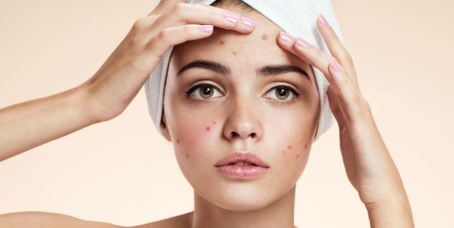 Acne From Beauty to Self-Confidence | Moore Road Medi Spa